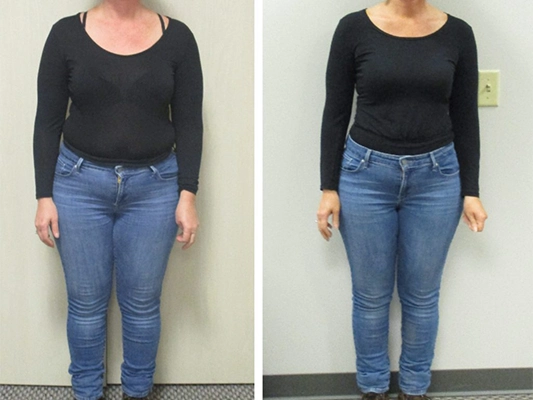 Weight Loss Brookfield WI Before And After