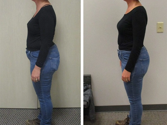 Weight Loss Brookfield WI Before And After