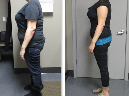 Weight Loss Brookfield WI Before And After