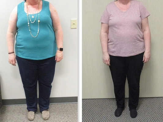 Weight Loss Brookfield WI Before And After