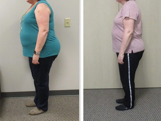 Weight Loss Brookfield WI Before And After